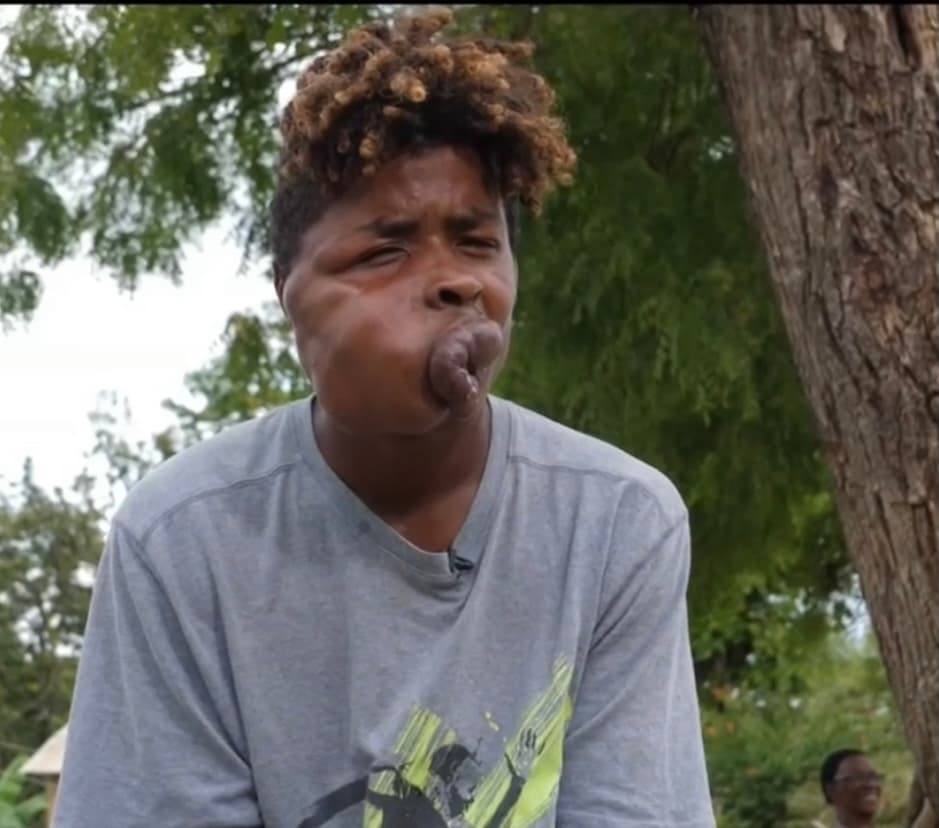 La fortaleza mental de Freddy también ha pasado por digerir sin atormentarse las burlas crueles de la comunidad que le dicen que
<b>“no voy a conseguir mujer por ser feo”</b>. Pero poco le importa. “He visto a gente con este problema y viven bien”, dice.
<br>