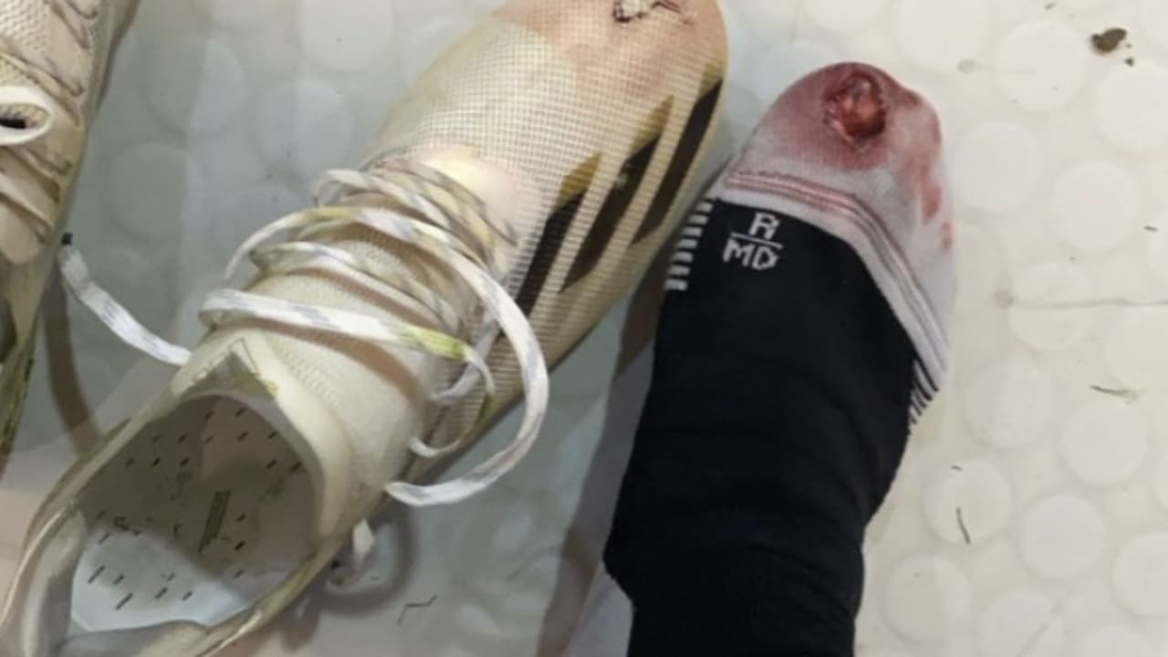 ¡Destrozado! Así quedó el pie Sebastián Córdova tras Preolímpico