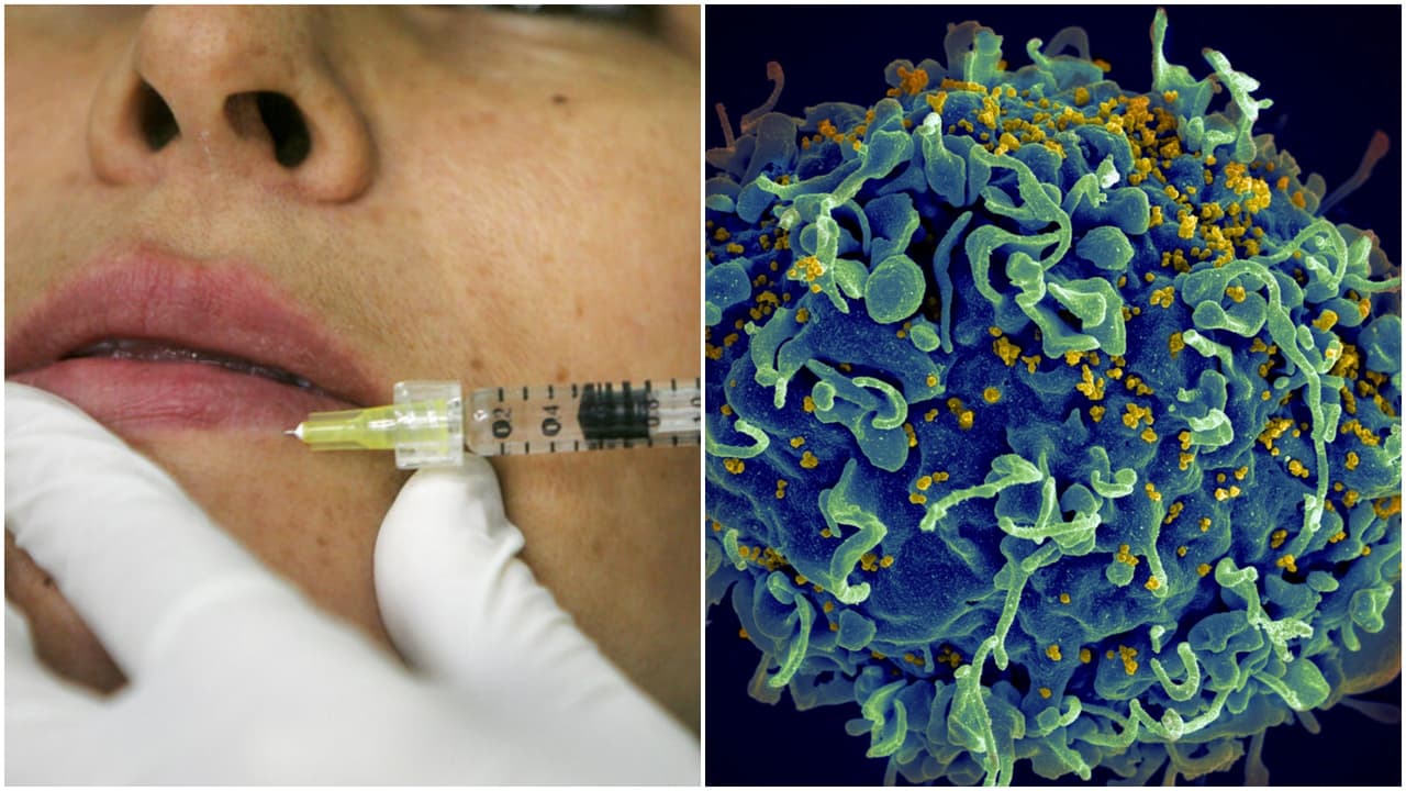 Qué es el “facial vampiro”, el tratamiento vinculado con casos de VIH