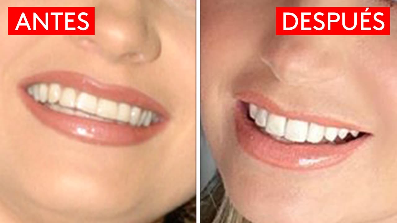 En la siguiente comparativa se puede disntinguir mejor la diferencia. En la foto de la izquierda (tomada en el año 2004) sus dientes aparecen más pequeños. En la de la derecha (del 9 de marzo de 2019) su dentadura aparece mucho más grande, con una forma más cuadrada en los frontales y con mayor blancura.