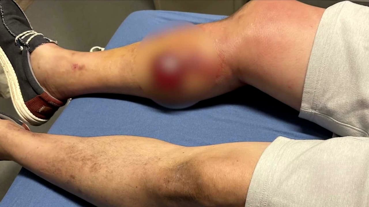 Ricardo López queda 20 días hospitalizado tras aparente picadura de araña en el norte de Texas