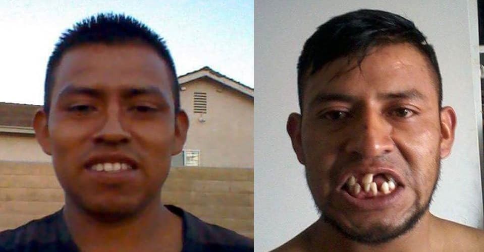 Luis Loza, residente de Oxnard, California, cuenta que un fuerte golpe en el rostro le ha dejado sin dientes y con un tremendo adeudo con un hospital.
