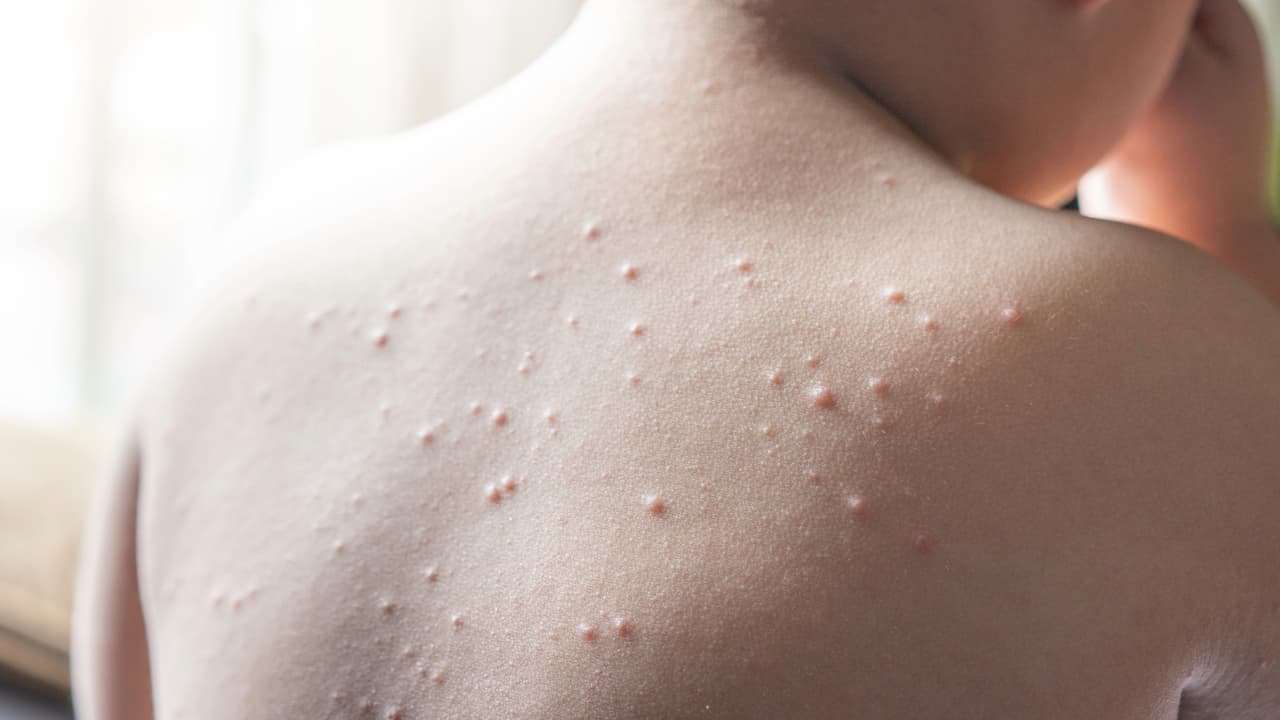 Reportan el primer caso de sarampión en un niño en el Condado Williamson