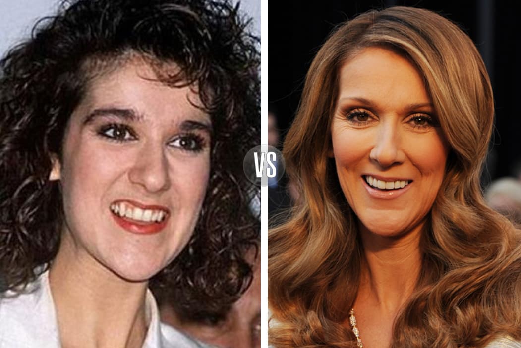 La que también le dio el toque mágico a su rostro fue Celine Dione. La diferencia entre el antes y después en sus dientes es notoria.