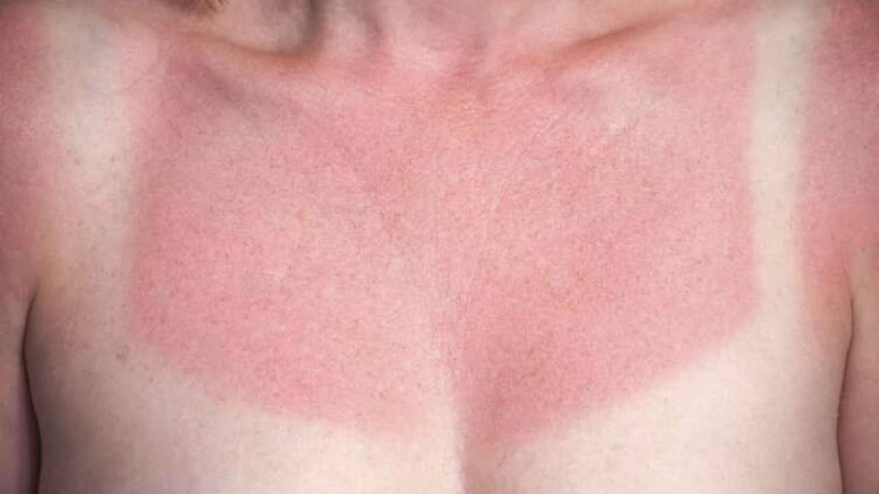 Ten especial cuidado para proteger la piel quemada por el sol mientras sana. 
<b>Usa ropa que cubra tu piel cuando estés al aire libre</b>. Las telas de tejido apretado funcionan mejor. Cuando sostienes la tela frente a una luz brillante, no deberías ver pasar ninguna luz.