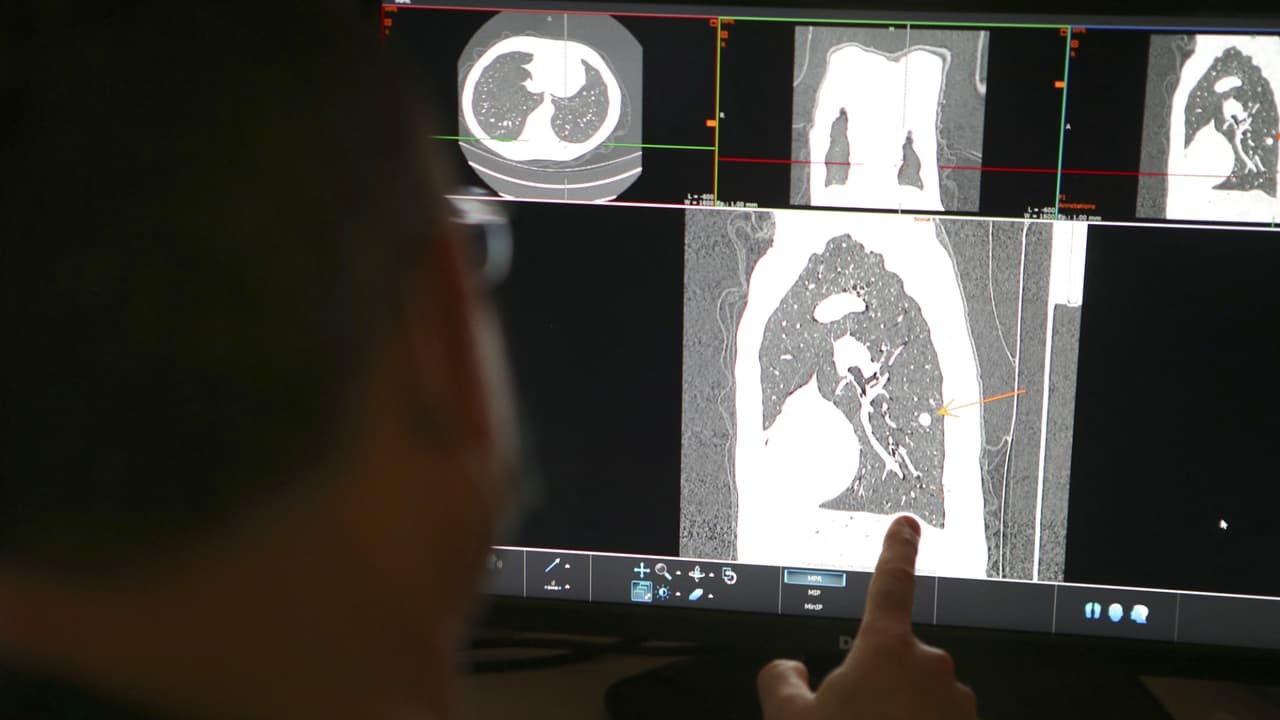 Nuevo informe sobre cáncer de pulmón ubica a Georgia entre los peores estados en supervivencia