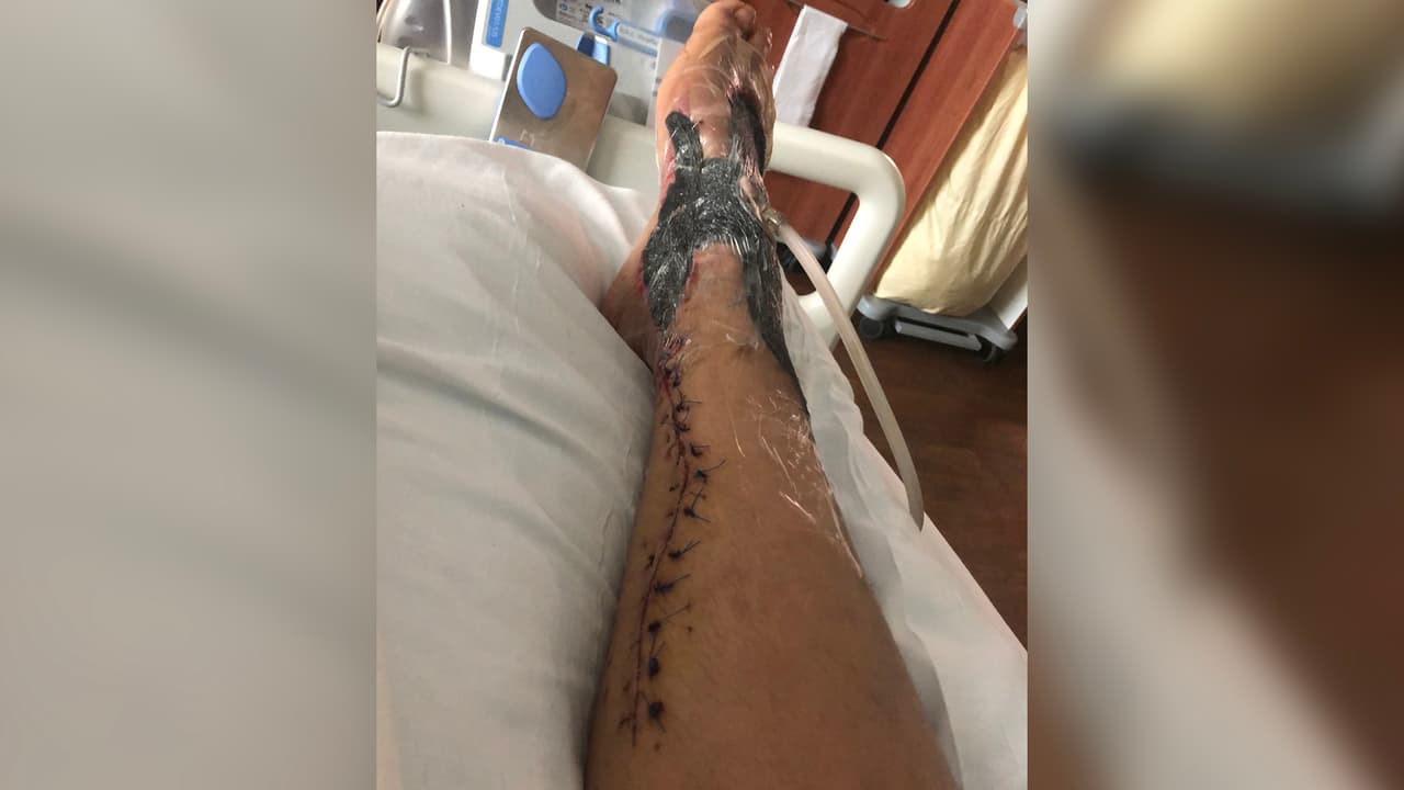 Lou fue enviada al
<a href="https://www.utmbhealth.com/" target="_blank">Centro Médico de la Universidad de Texas en Galveston (UTMB)</a> donde la operaron de emergencia y luego tuvo que ser intervenida cuatro veces más: "Me dijo el doctor que era afortunada de no perder el pie porque la mayoría de estos casos es amputacion", cuenta.