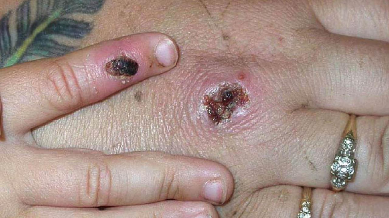 Un texano que padece viruela del mono se fugó de un hospital en México y viajó a Dallas. ¿Hay sanciones por volar enfermo?