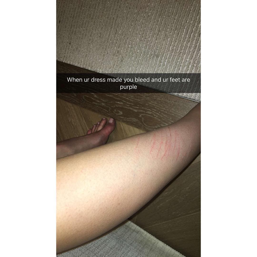 Terminó muy rasguñada por las piedras de su vestido.