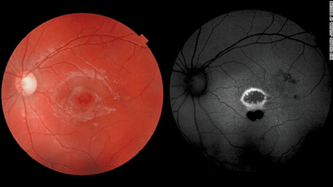 Jugó con un puntero láser y perdió la visión en un ojo: por qué hay que mantener estos objetos fuera del alcance de los niños