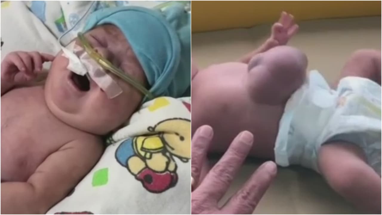 Ayuda de Impacto: Bebé nació con el corazón fuera de la cavidad torácica