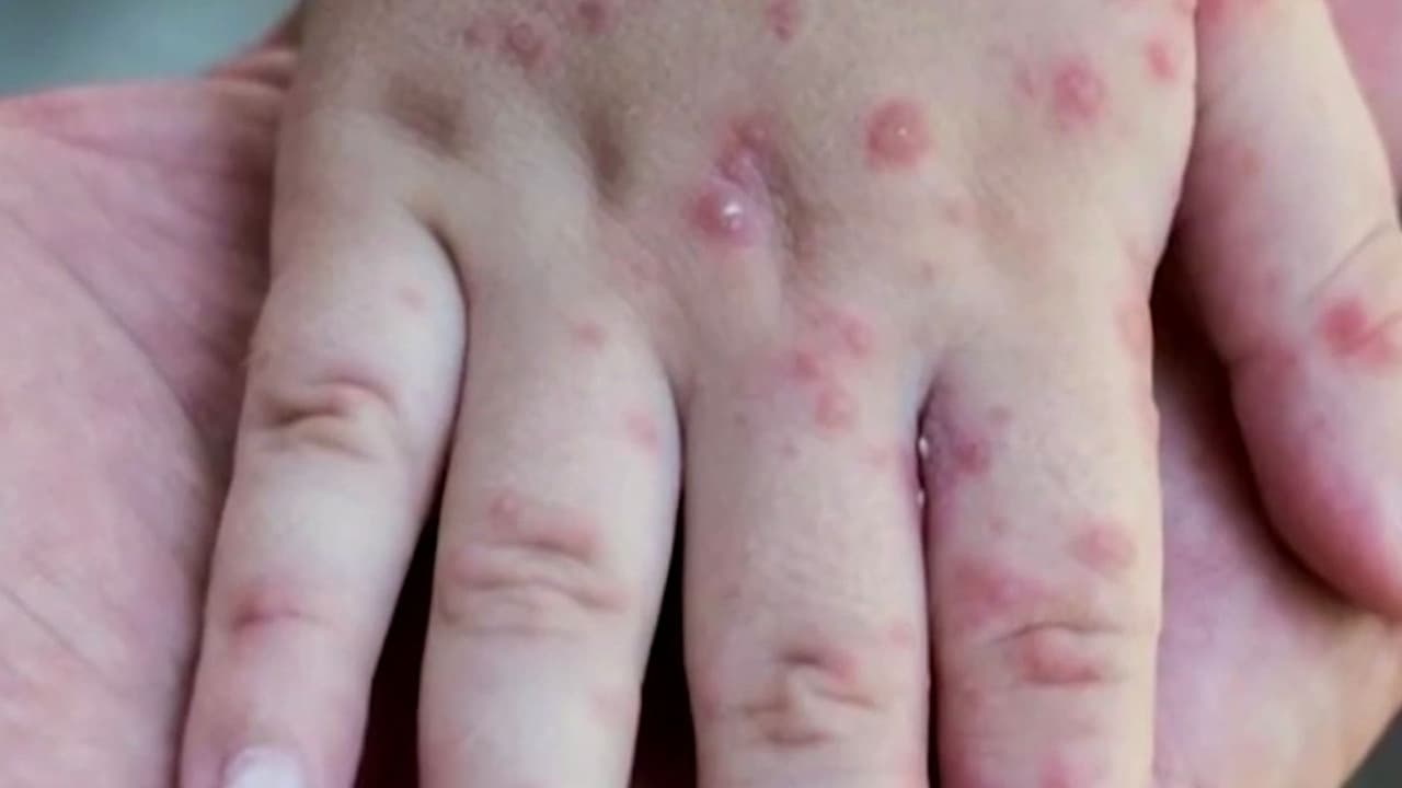 Autoridades en México intentan contener brote de sarampión; intensifican estrategia de vacunación en la capital