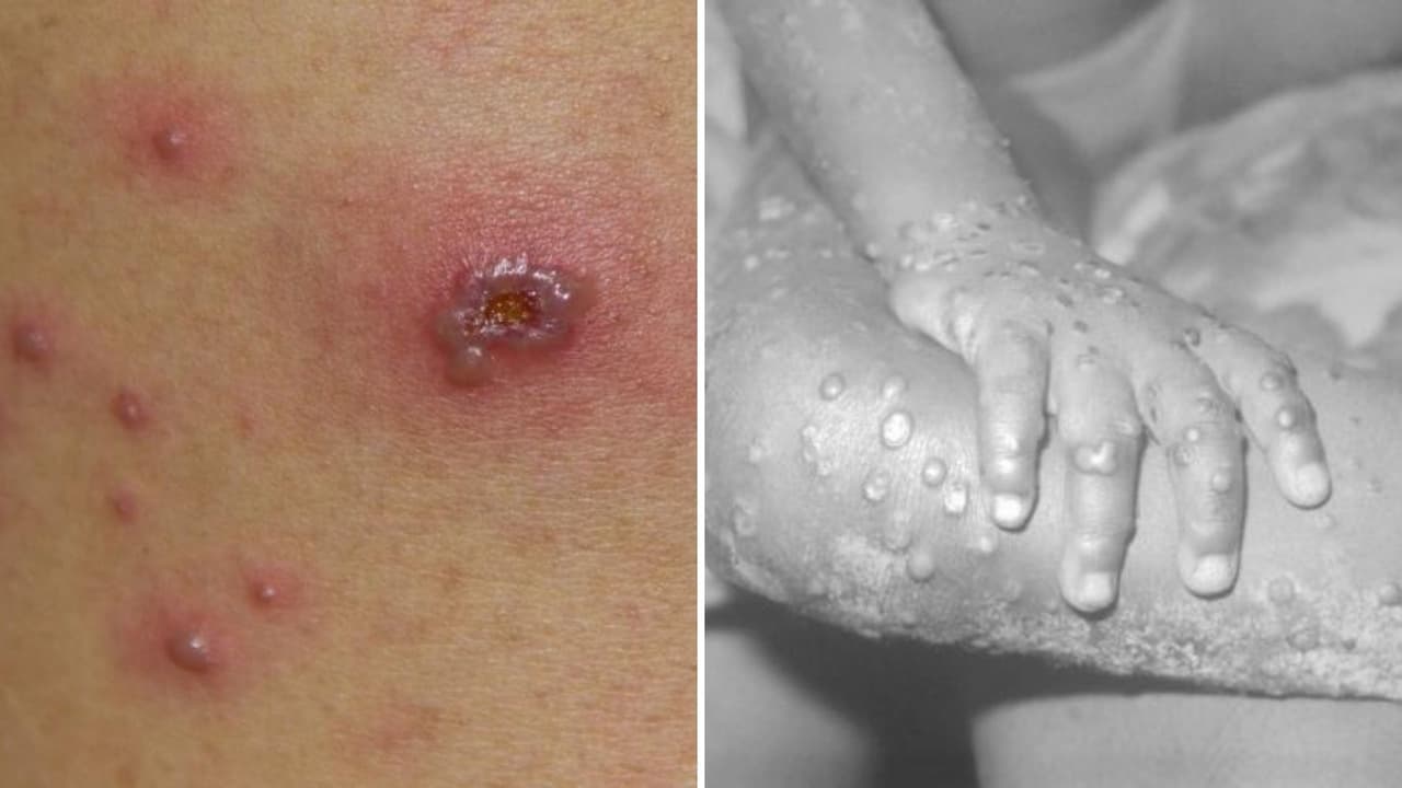 Viruela del mono: clínicas y recursos en el condado de Fresno 