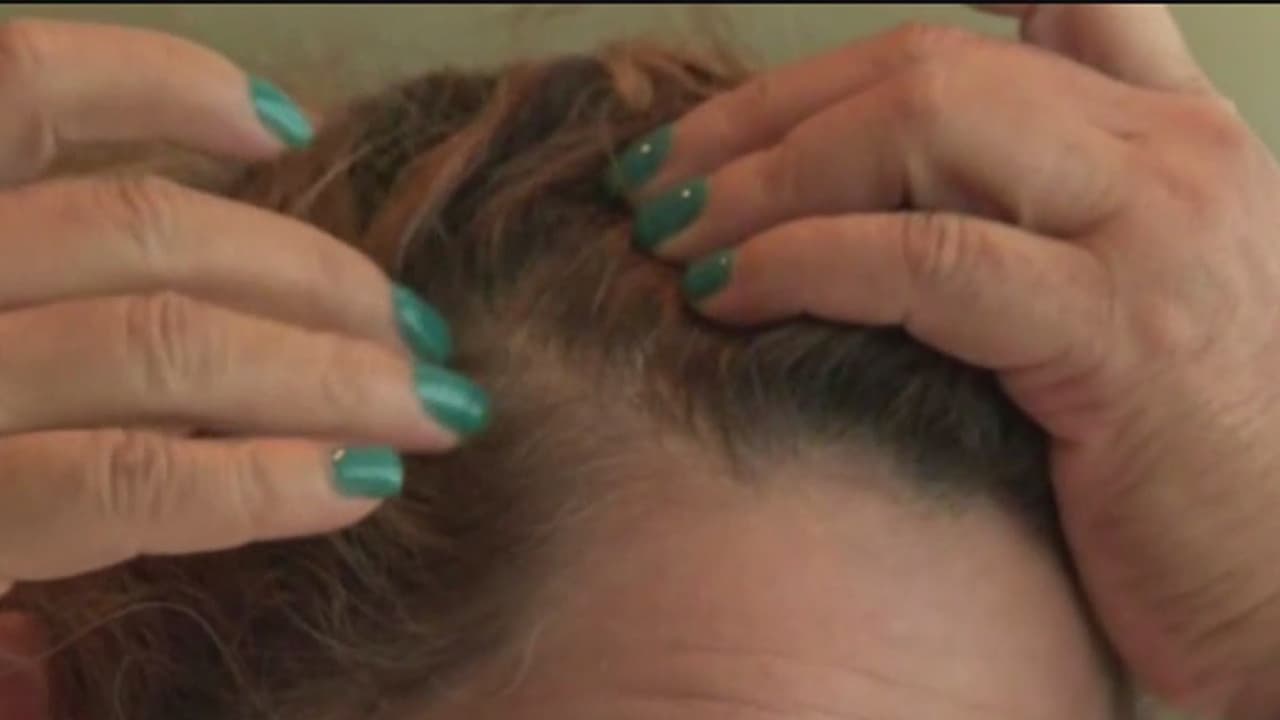 “La pérdida de cabello es diaria y mucho más abundante”: mujer supera al coronavirus pero advierte de secuelas