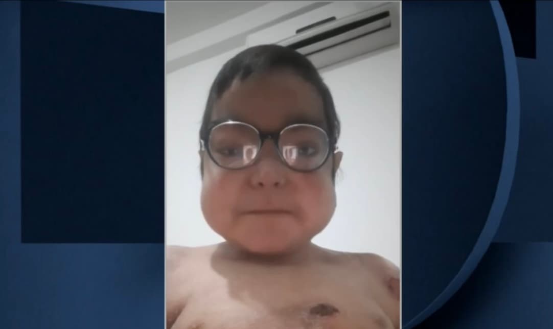 Ángel dice sentirse muy deprimido y sueña con salir de su natal Venezuela y vivir en un lugar donde el clima sea más frío para no tener tantas complicaciones por su piel.
<br>