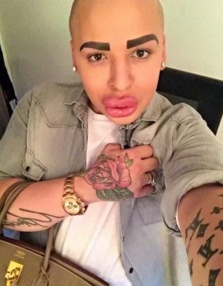 El chico adora las inyecciones en los labios y admite que entre tenga más, para él mejor.