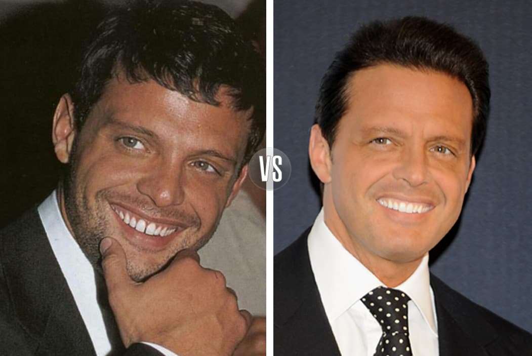 Luis Miguel también se encuentra en esta lista, el cantante tenía los dientes separados y pasados algunos años se hizo el arreglito que le cambió la vida.