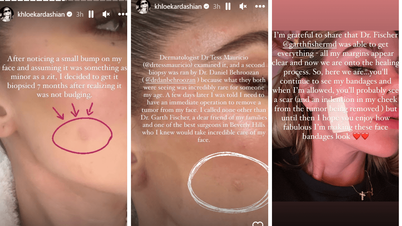 Khloé Kardashian compartió detalles sobresu salud, tras haberle extirpado un melanoma.