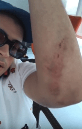 Además, él también realizó una transmisión en directo desde Instagram donde mostró las heridas provocadas por su caída.