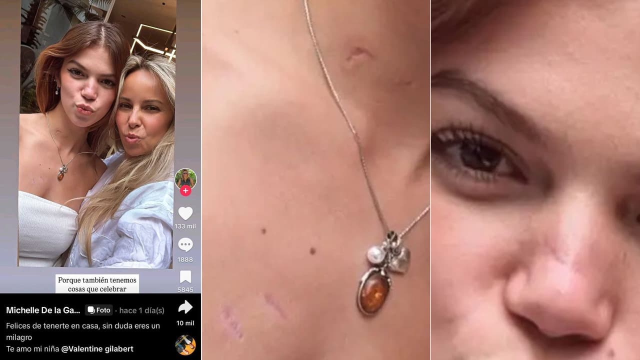 Valentina Gilabert quedó con cicatrices tras el ataque del que fue víctima.