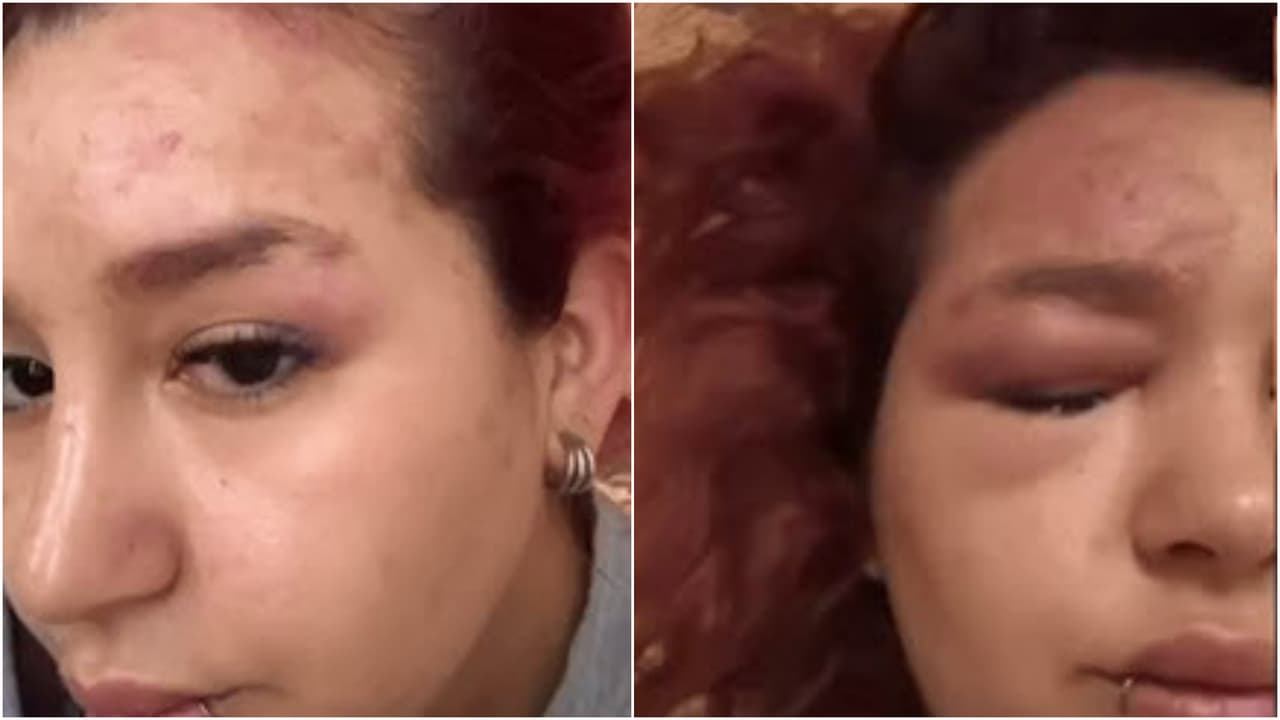 Romina Marcos reapareció con rostro cubierto parcialmente para tapar las costras.