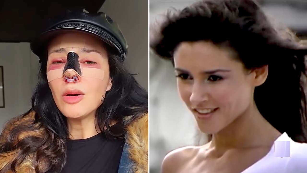 Modelo que fue parte de Sábado Gigante y El Gordo y La Flaca queda “desfigurada” tras cirugía estética