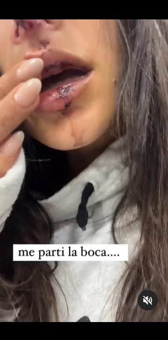 <b>"Me partí la boca…"</b>, continuó.
<br>