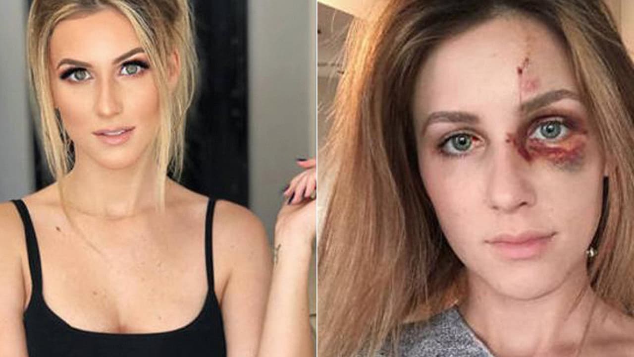 Campeón de motocross le pegó a su novia modelo por publicar una foto: ella lo denunció y mostró cómo la dejó en rechazo a la violencia doméstica