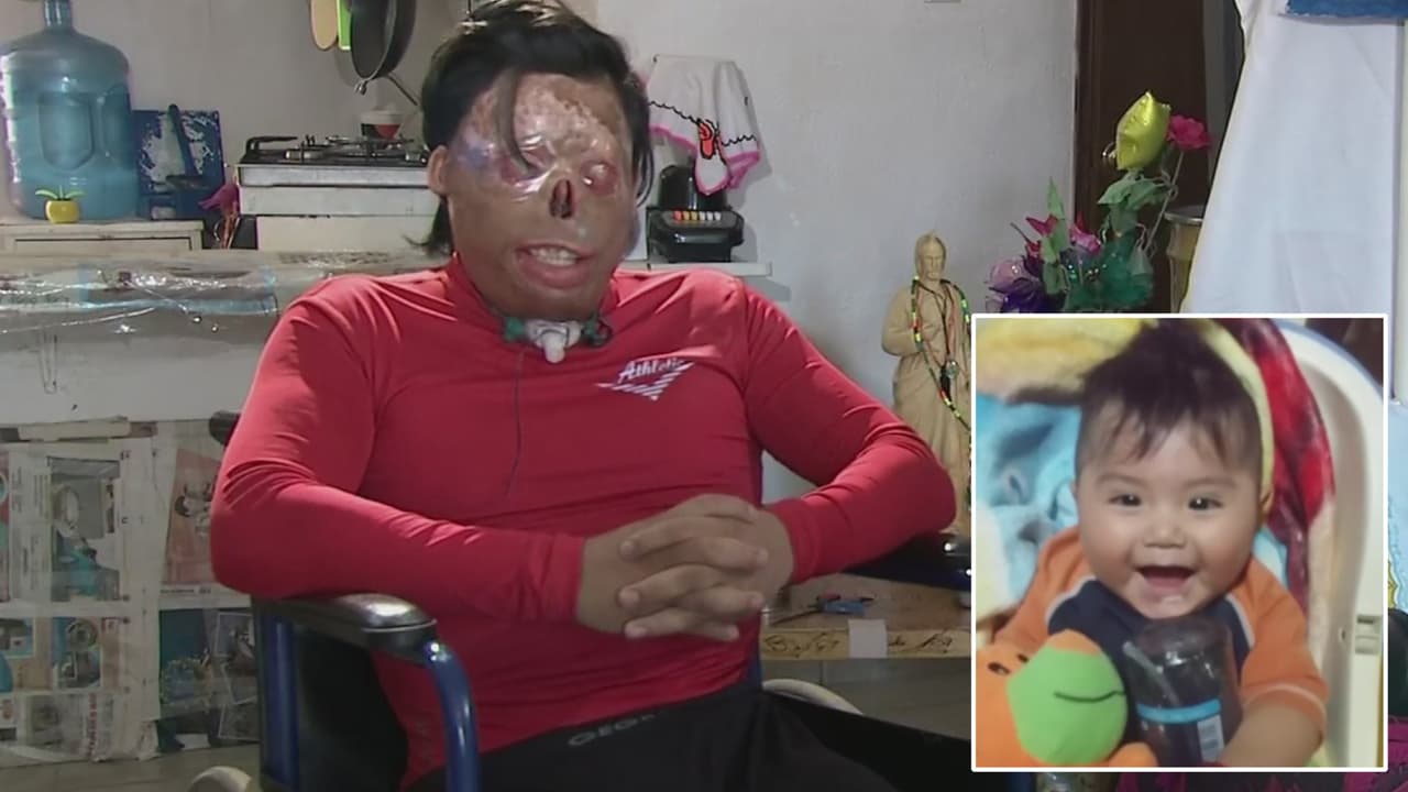 Recuperar a su hijo y mejorar su salud: el sueño de este hombre que sufrió quemaduras en su cuerpo 