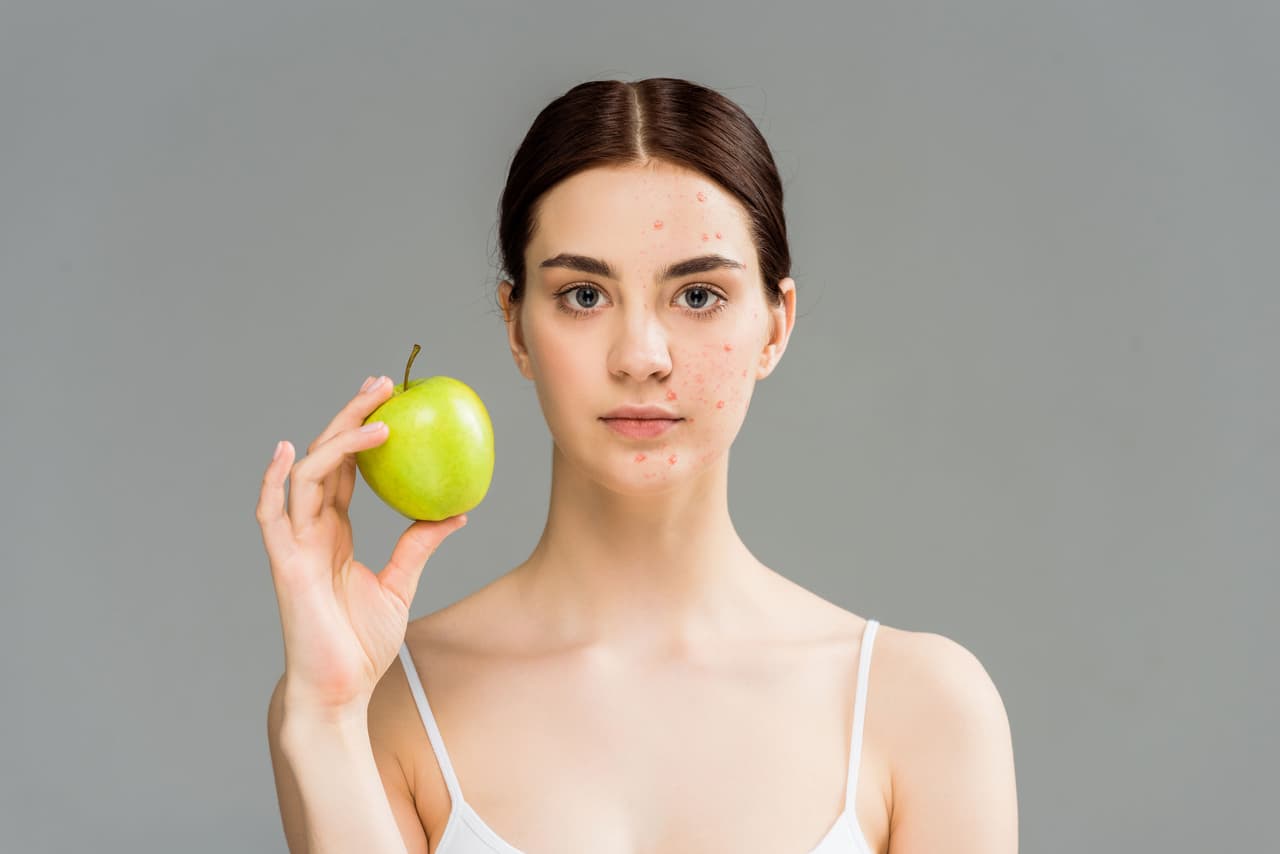 <b>Elimina el acné.</b> Las mascarillas de manzana son muy comunes por los altos niveles de antioxidantes que tiene esta fruta. La manzana, aplicada directamente en el rostro, ayuda a eliminar las espinillas y los granos.