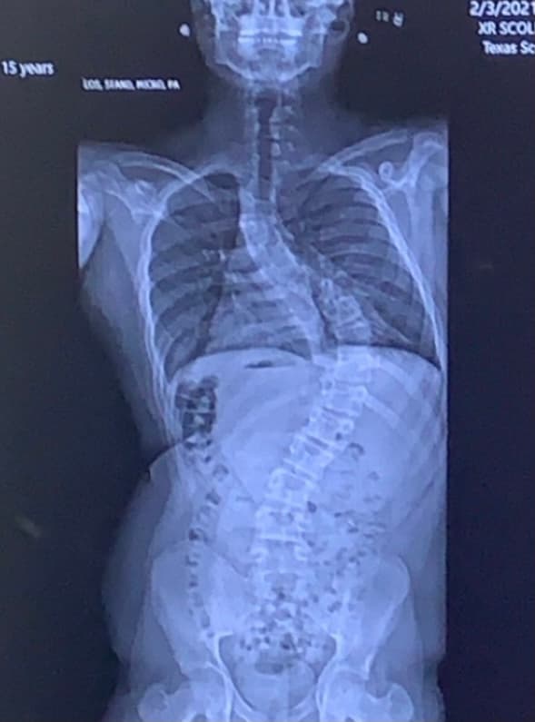 En junio del 2020 los doctores le dijeron que la curva en su espalda había crecido 59 grados y recomendaban la cirugía.