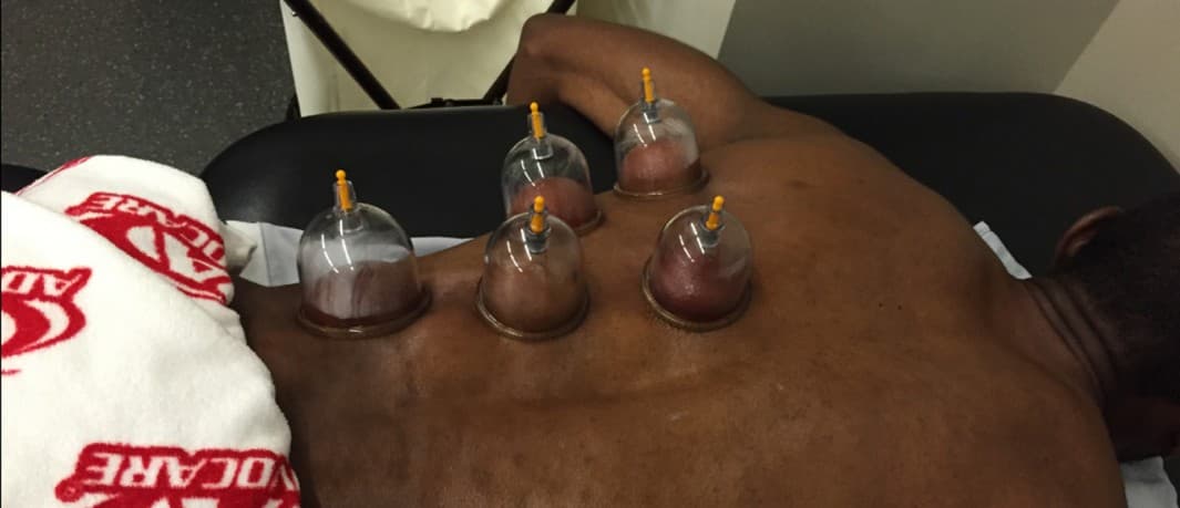 Jugadores utilizan la "ventosaterapia"