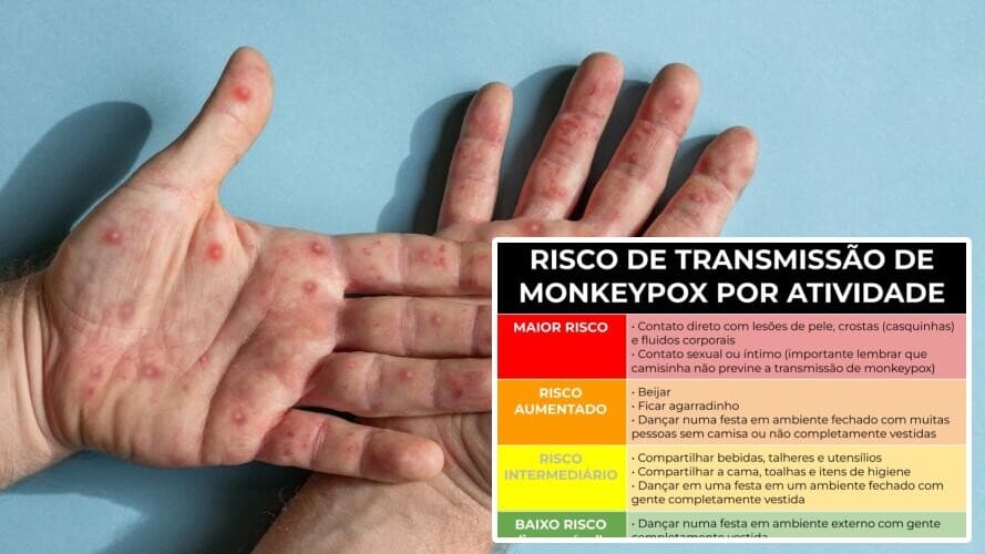 Tabela criada por médico ajuda a entender risco de pegar varíola dos macacos: situações diárias