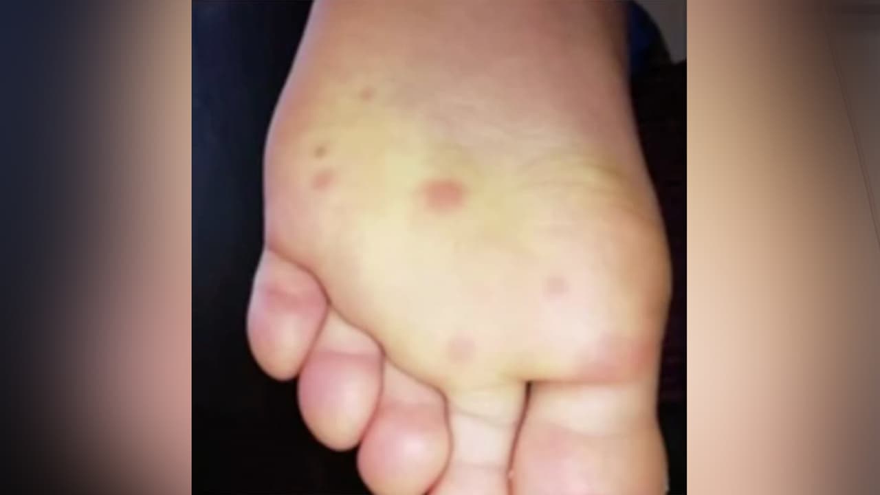 Nuevos síntomas del 
<a href="https://www.univision.com/local/houston-kxln/atacan-amenaza-de-coronavirus-con-robots-en-houston-video">covid-19</a> han sido detectados en pies, manos y algunas veces en la espalda de niños y adolescentes.