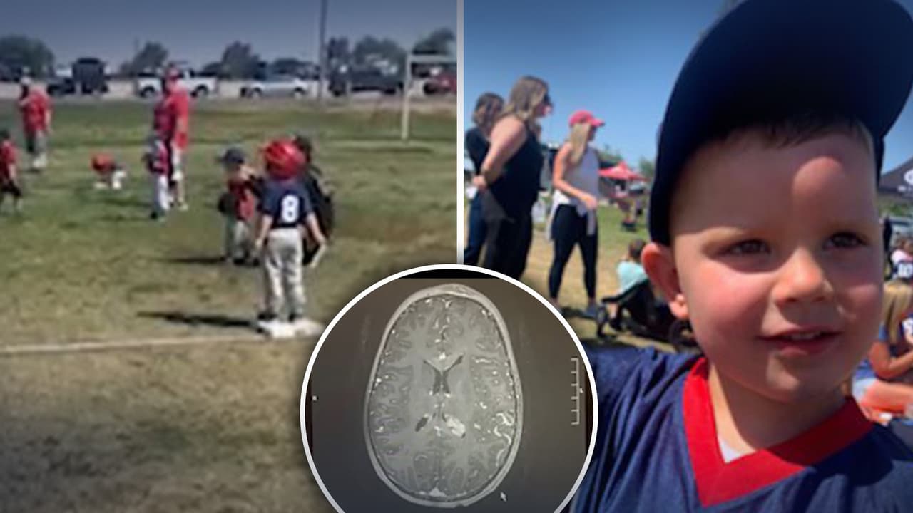 Un golpe en la cabeza durante un partido de béisbol salva la vida de niño de tres años