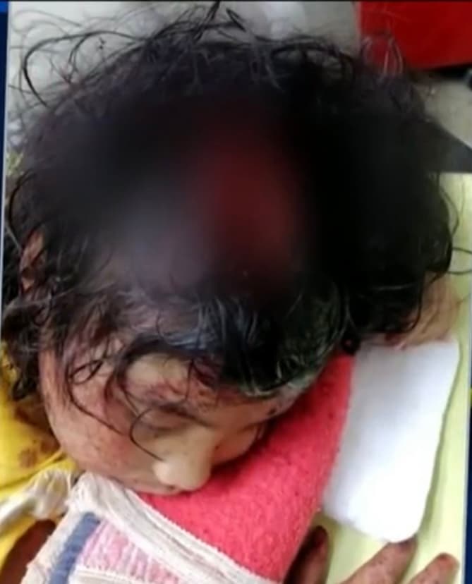 Una niña de 6 años que estaba bajo el cuidado de su tía fue atacada brutalmente por un perro que se metió a la vivienda,
<b> destrozándole gran parte de su cuero cabelludo. </b>
<br>