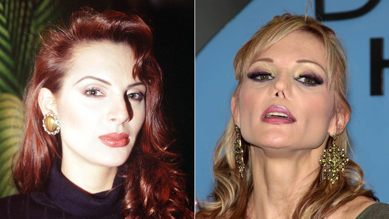 <b>Carmen Campuzano</b>: la modelo mexicana tuvo constantes problemas con las drogas que le ocasionaron una grave infección en la nariz, por lo que se sometió a varias operaciones de rinoplastia que le deterioraron su bello rostro.
<br>
<br>