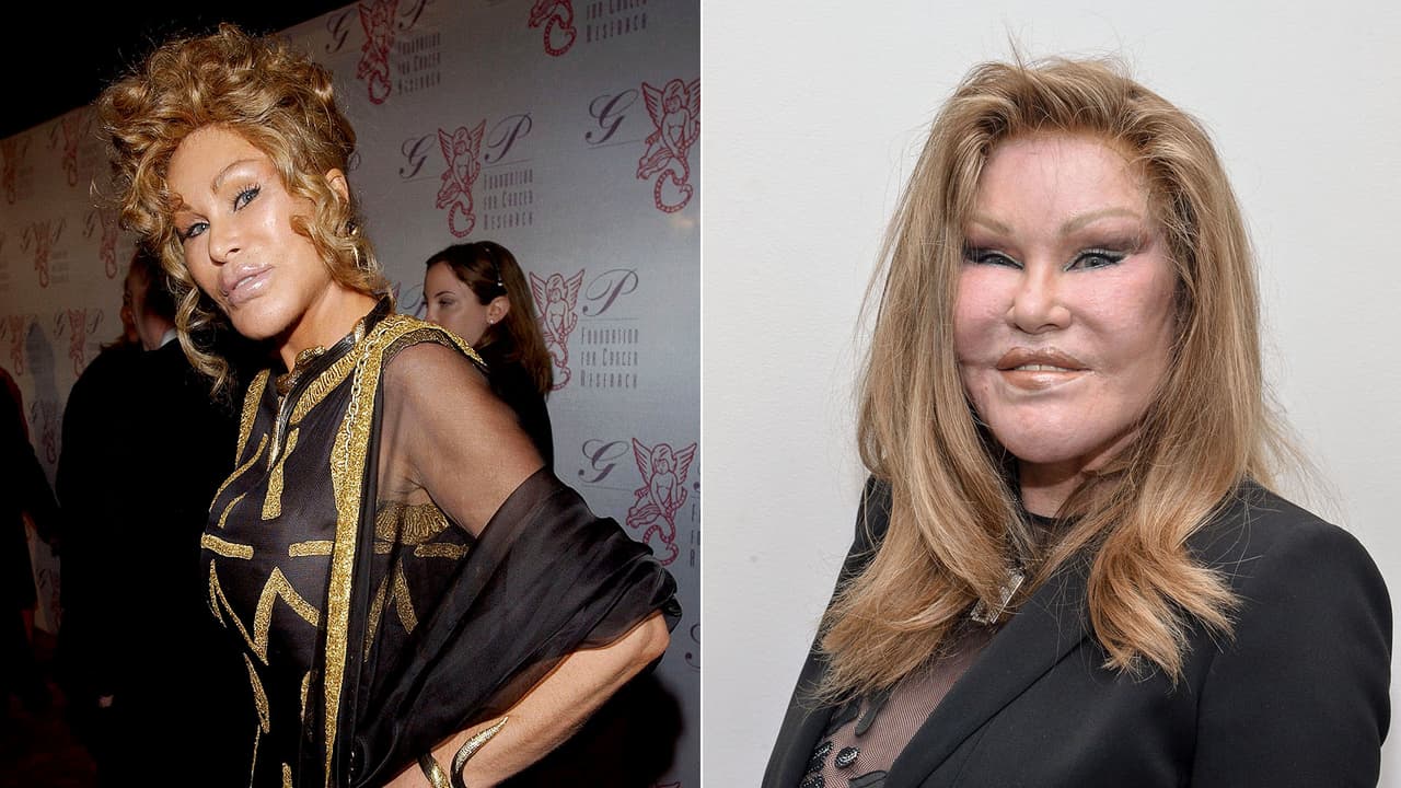 <b>Joselyn Wildenstein</b>: buscó a través de las operaciones parecerse a los felinos y a pesar de sus más de 30 intervenciones, confiesa que no se detendrá y seguirá visitando el quirófano.
<br>
<br>