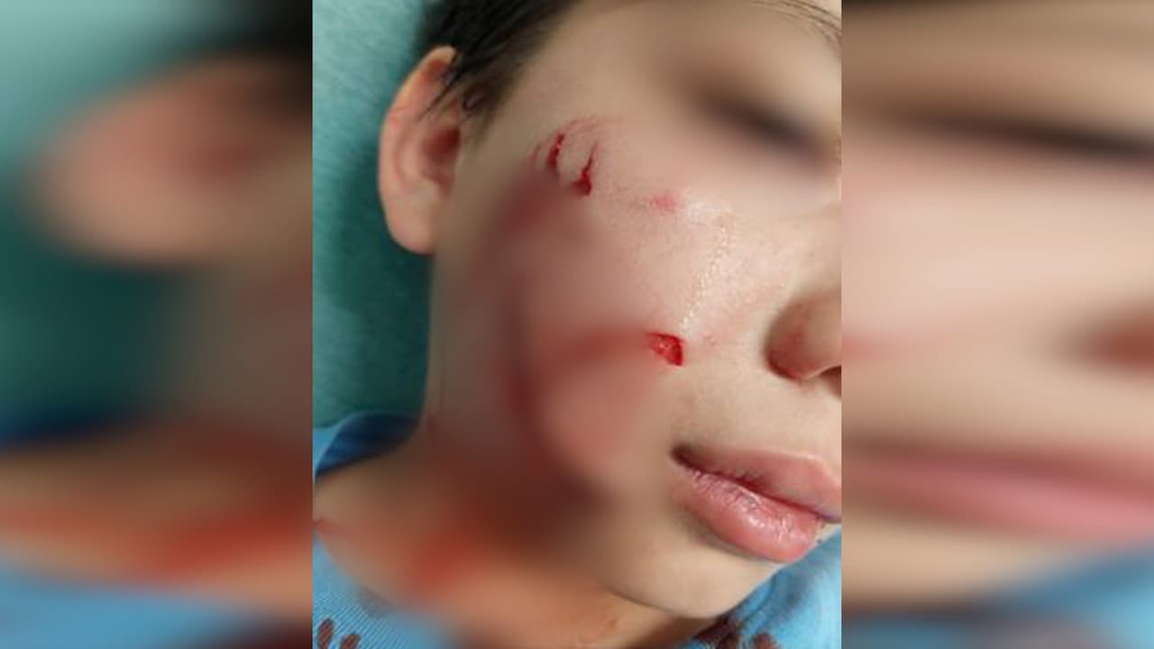 Madre hispana denuncia que su hijo fue atacado por el pitbull de un vecino en Charlotte