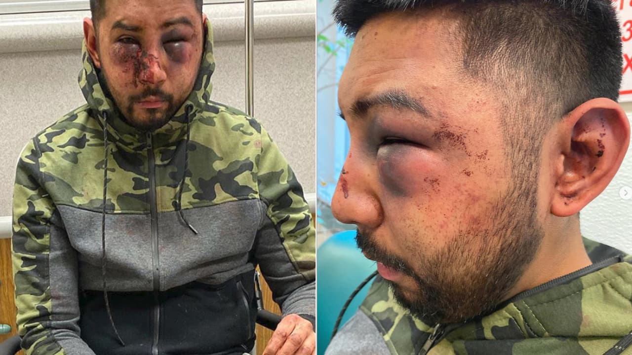 "Me dejaron la cara desfigurada": hombre alega que oficiales le hicieron comentarios racistas y lo dejaron moreteado y sangriento