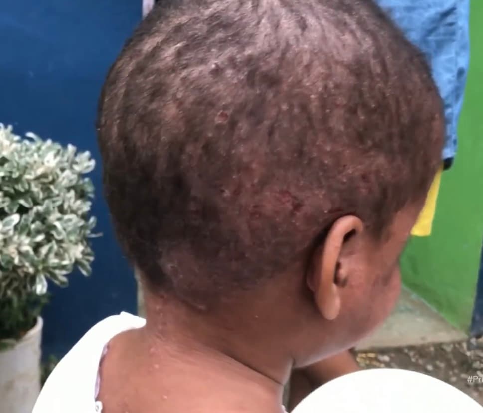 Y es que para Dayri Contreras Ramírez, la vida no ha sido fácil. En aquella comunidad dominicana de San Pedro de Macorí lucha contra una picazón asfixiante que le provoca llagas en su piel llena de sangre por tanto dolor. 
<br>