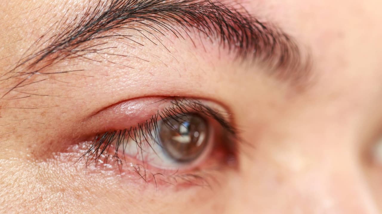 ¿Los orzuelos en los ojos son peligrosos? Dr. Juan explica por qué aparecen y cómo tratarlos
