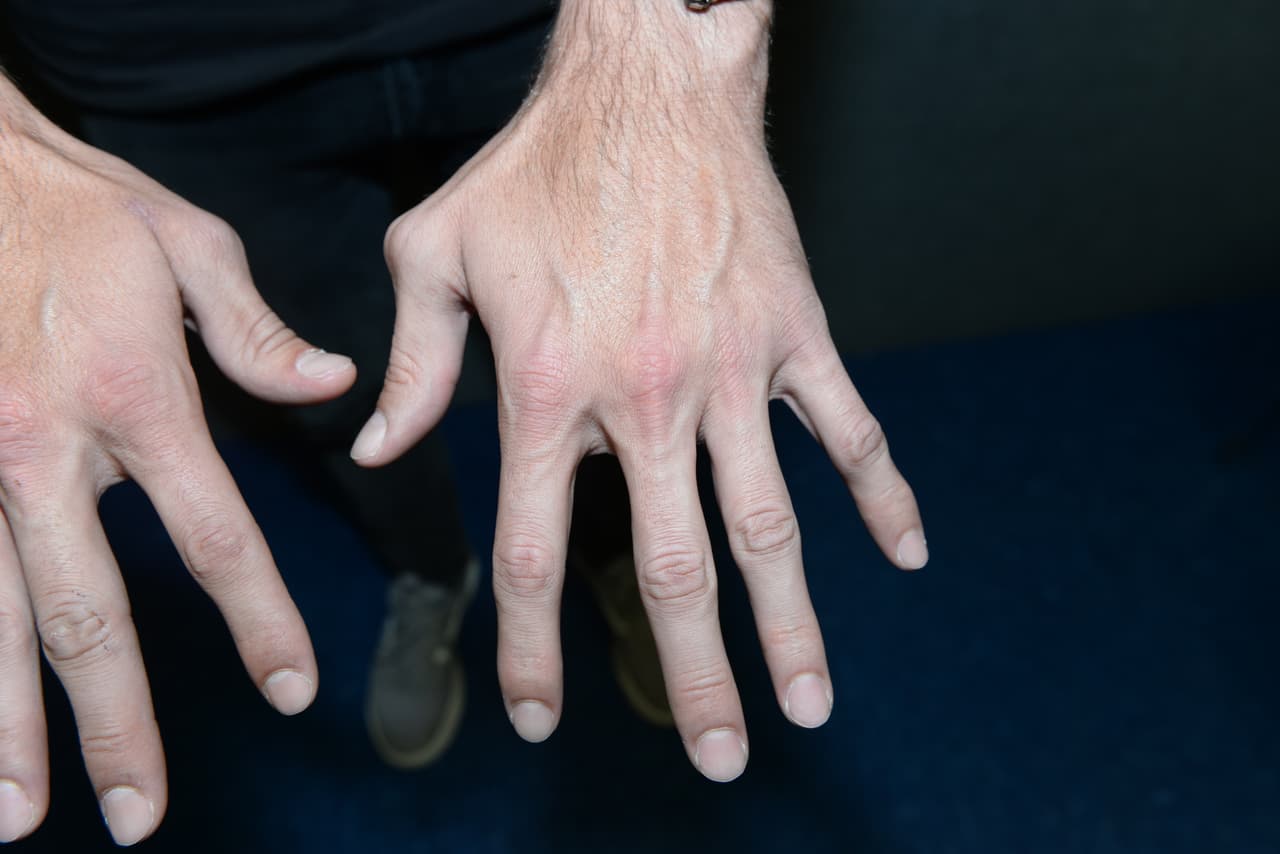 Así estaban las manos de Lyle el día que le dio el golpe a Juan Ricardo Hernández.