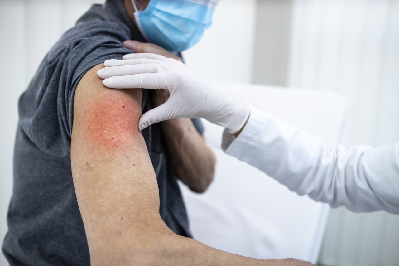 Los CDC también han recibido reportes de que algunas personas han experimentado un sarpullido rojo, con comezón, inflamado o doloroso en el lugar donde recibieron la inyección. Estas erupciones pueden comenzar desde unos días hasta más de una semana después de la primera inyección y, a veces, son bastante grandes.