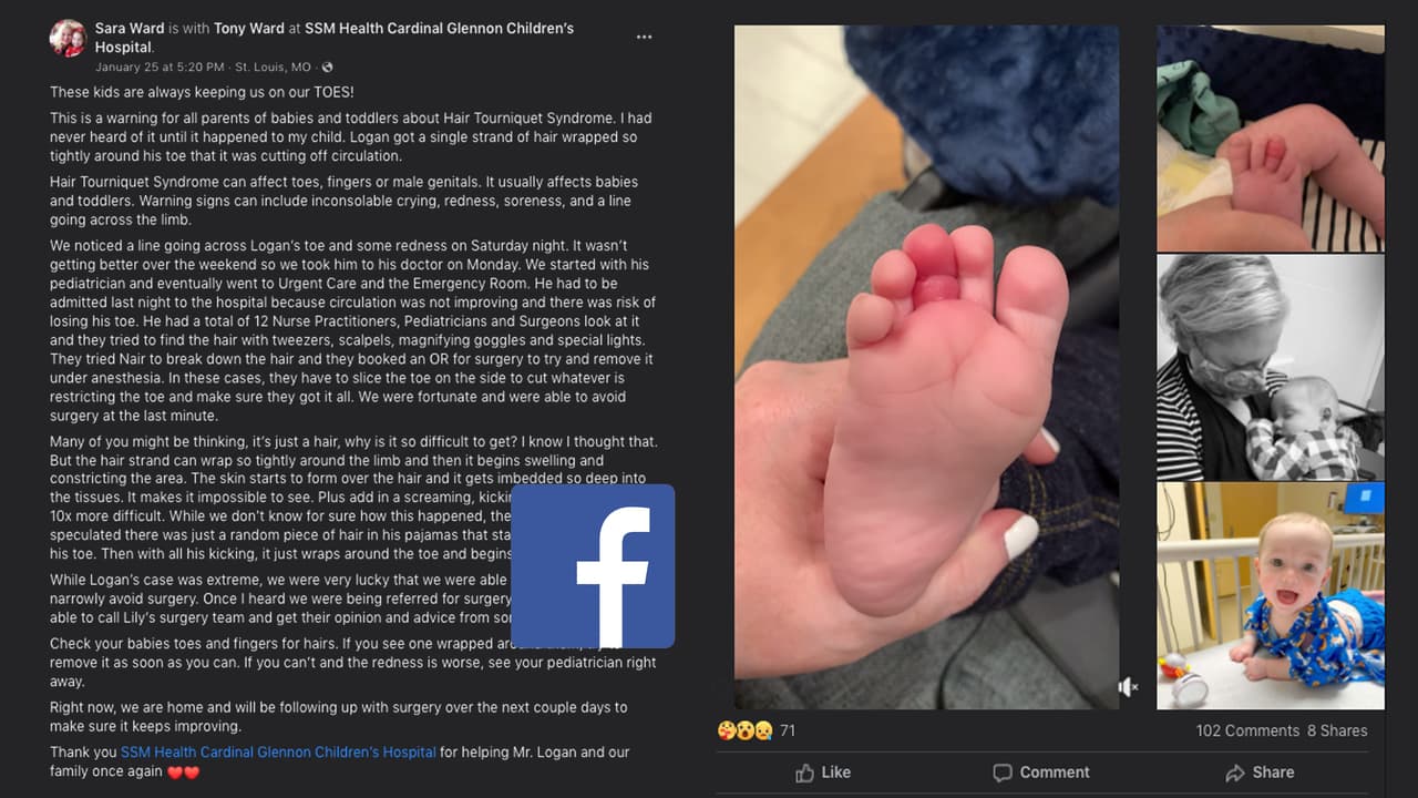 La madre relató lo ocurrido en Facebook para alertar a otros padres sobre el raro síndrome del torniquete en bebés.