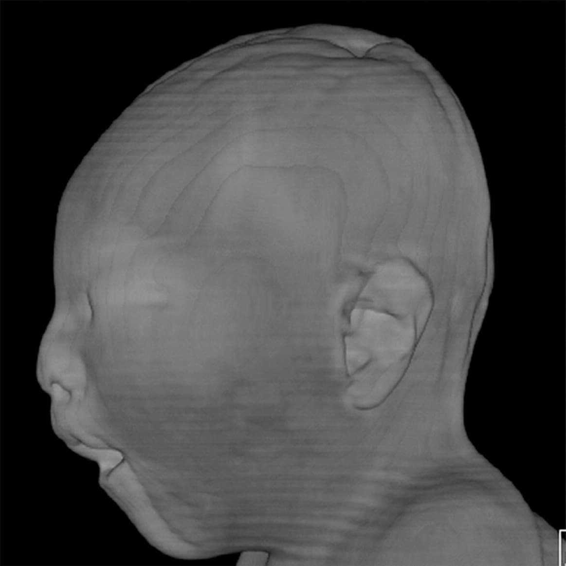 A las 17 semanas el tamaño de la circunferencia de la cabeza del feto estaba dentro del rango normal.