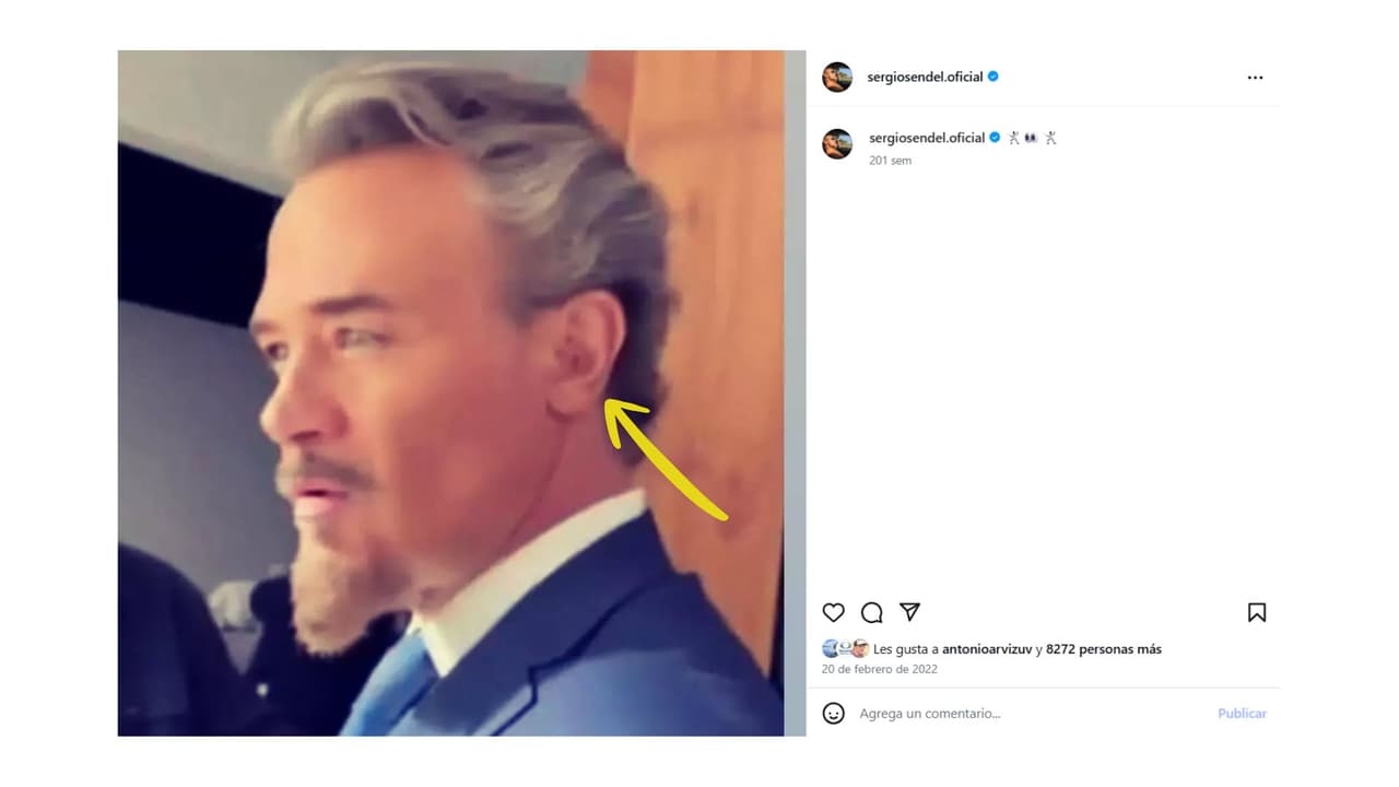 El actor habría desistido de la cirugía que quitaría el hoyito que le dejó un absceso.