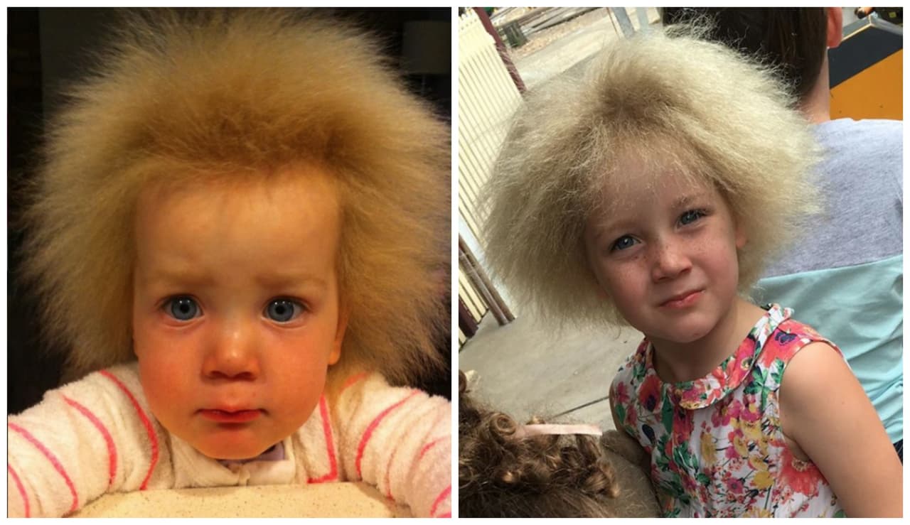 La madre de la pequeña Shilah Calvert Yin ha abierto una cuenta en Instagram para alentarla a estar orgullosa de tener ''Síndrome del pelo indomable'.