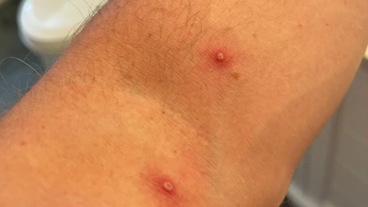 ¿Vacuna contra la varicela protege de la viruela del mono? Dr. Juan explica todo sobre este virus