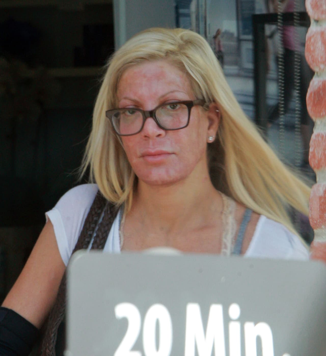 Hinchado y muy rojo.